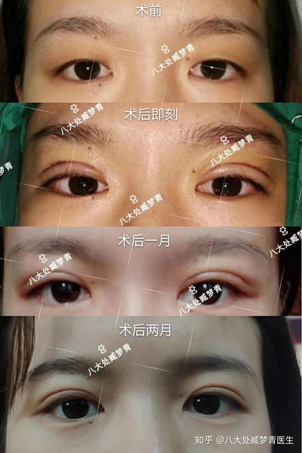 北京八大处双眼皮手术案例分享
