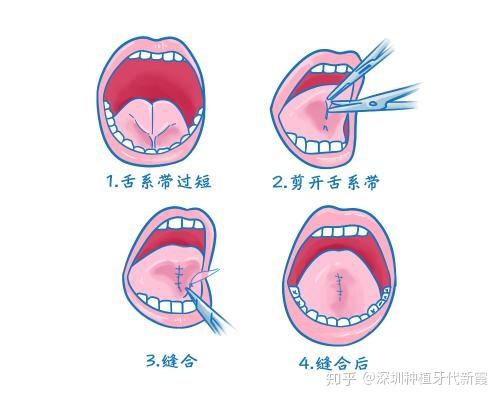 孩子舌系带过短一定要剪掉吗?何时手术最好呢? - 知乎