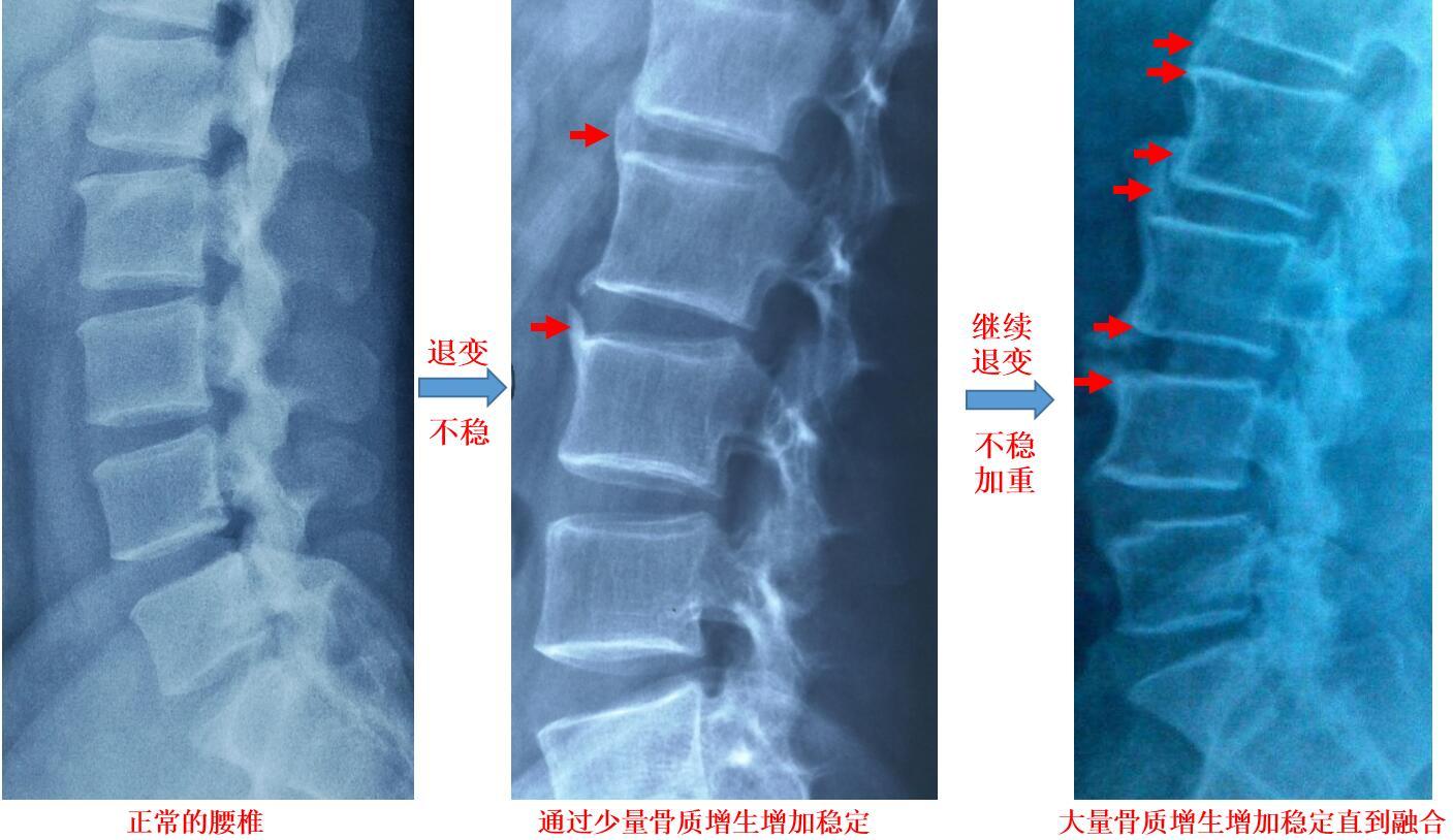 骨刺竟然是好东西原来我们一直都错怪骨质增生了