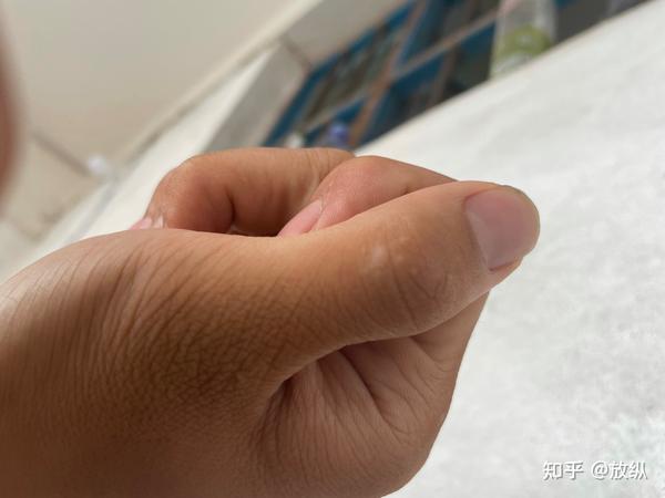 手上有几块小白点 无缘无故起的 不知道是什么东西 不会是白癜风吧?