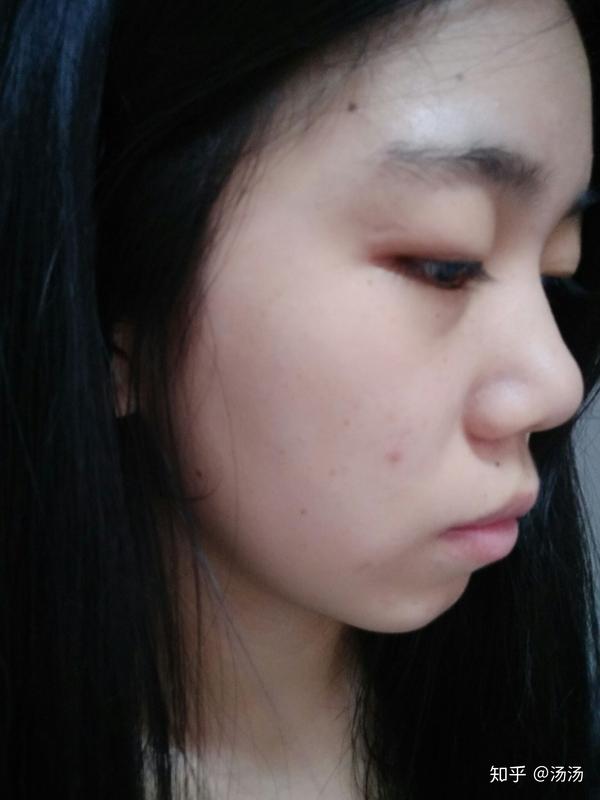 正脸好看侧脸丑 嘴凸没下巴怎么办啊?