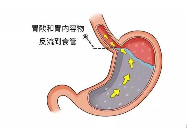 胃食管反流病是怎么一回事医生说今天一次性全告诉你