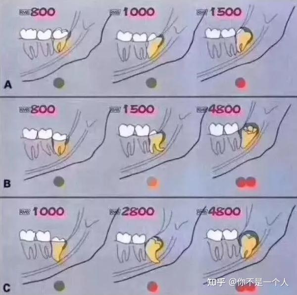 的阻生齿拔除比如下面价格图中的近中阻生智齿,低位