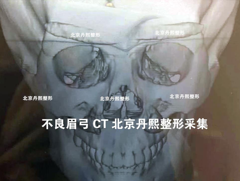 如何避免假体垫眉弓以后出现张飞眉不良眉弓形态ct展示