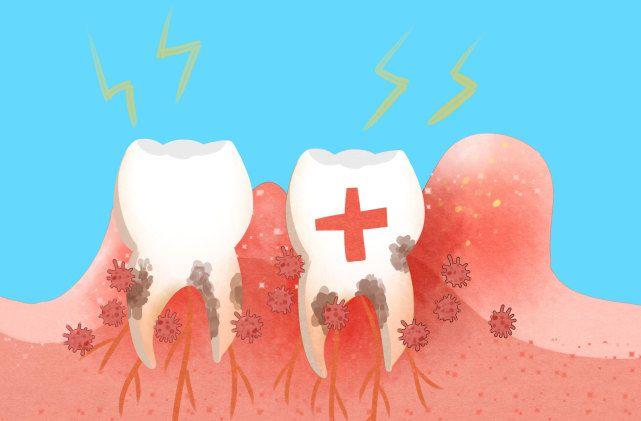 患了哪些疾病会导致牙龈出血