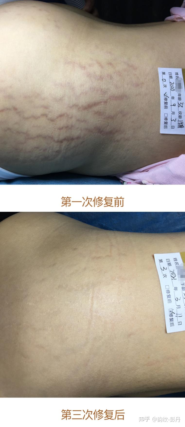 肥胖纹怎么办?