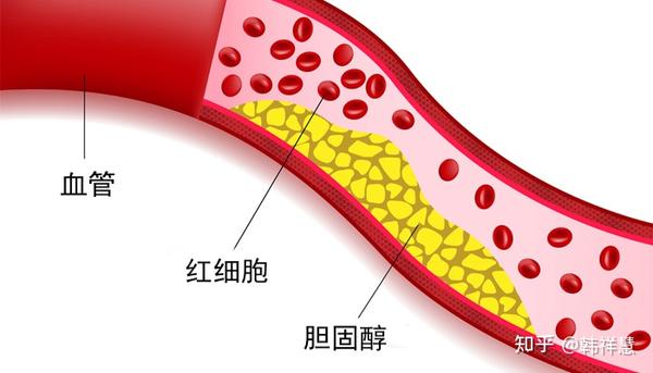 血液中的有两种主要脂质--甘油三酯和胆固醇: 甘油三酯是当身体储存