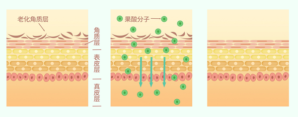 小协的答案是: 不要胡搞! 刷酸的原理简单来说就是