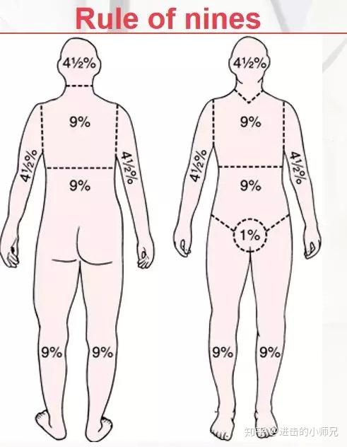 护士必会小技巧之烧伤面积计算