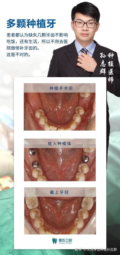 多颗种植牙案例