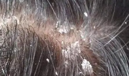 头屑也称头皮糠疹,是由马拉色菌感染诱发的头皮问题[1].