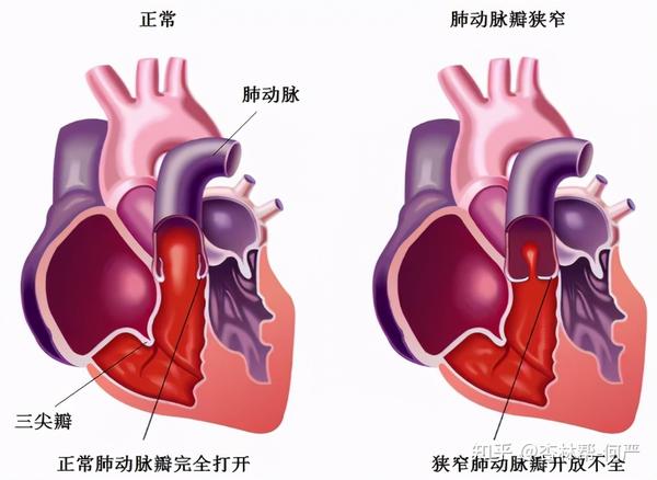 宝宝活动后胸闷,气短,耐力差,微创介入巧治肺动脉瓣狭窄