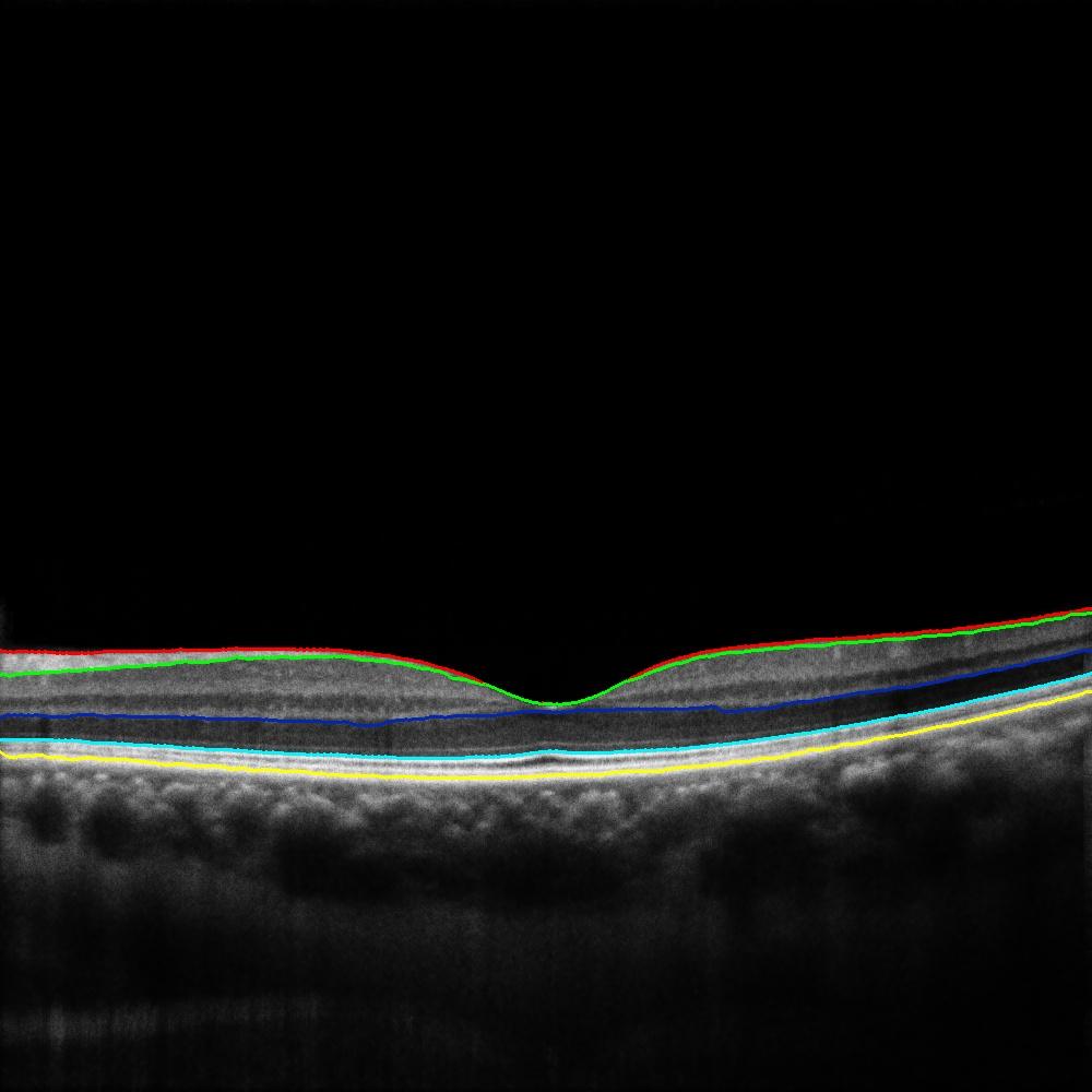 oct视网膜分层demo