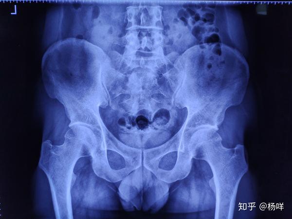 骨盆x光片分析(站立位,看片不求人
