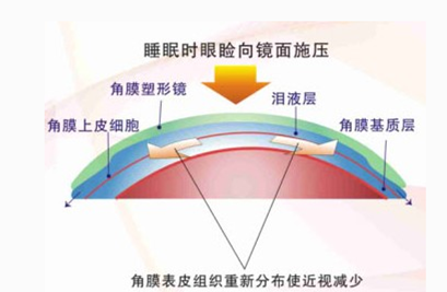 防控近视的角膜塑形镜佩戴方法