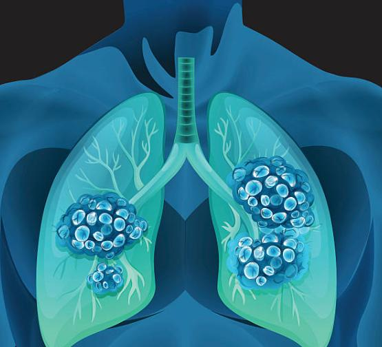 如何防止肺癌术后复发中医辅助治疗重要