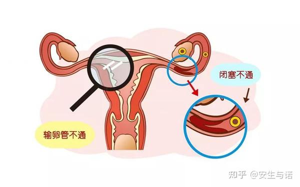 输卵管通而不畅,闭塞不通,对怀孕会有哪些影响?