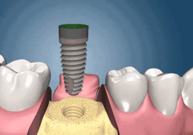 而最终的最佳种牙期主要是由专业的种植牙医生