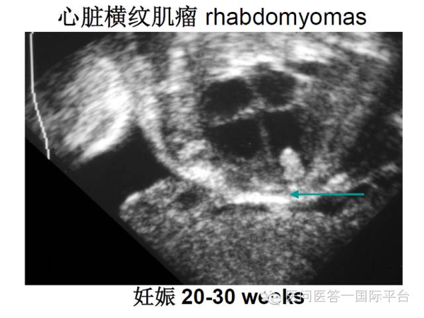 【长城会课件】张宏冰(part1):心脏横纹肌瘤的诊断和治疗
