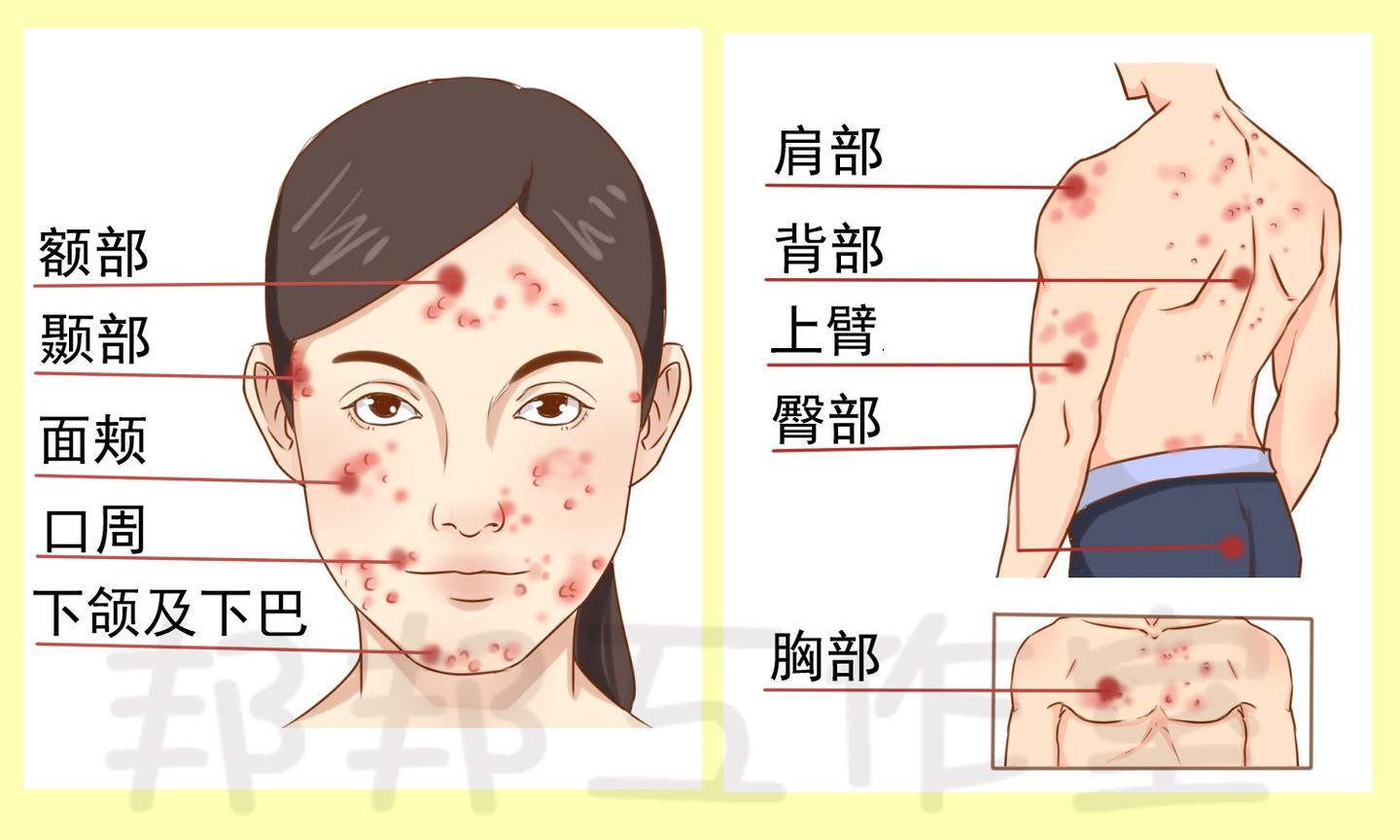 已认证的官方帐号 5 人 赞同了该文章 提到痘痘,大家都不陌生,而且