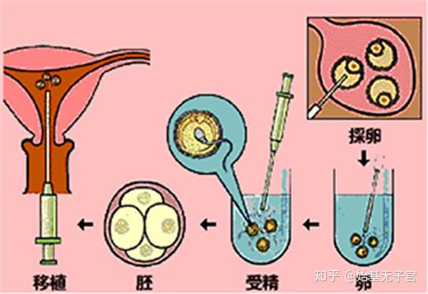 胚胎吸进连着注射器的移植导管,然后医生将导管插入到子宫腔内合适的