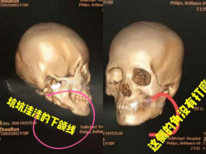 上海狗啃式下颌角磨骨坑坑洼洼,技术是真的烂,失败避雷医生