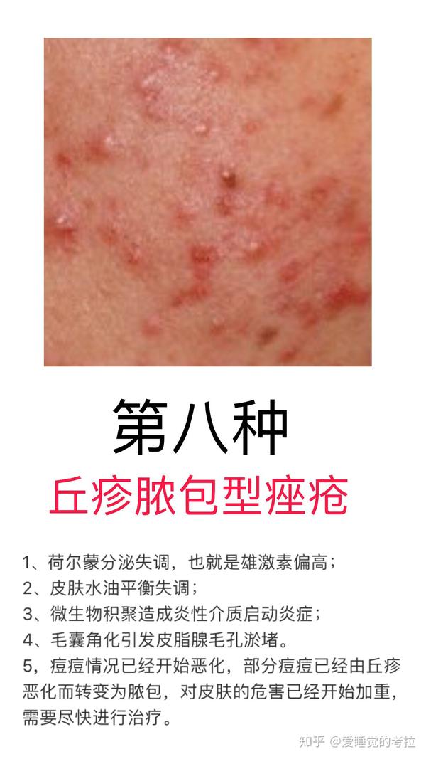 常见的痘痘类型