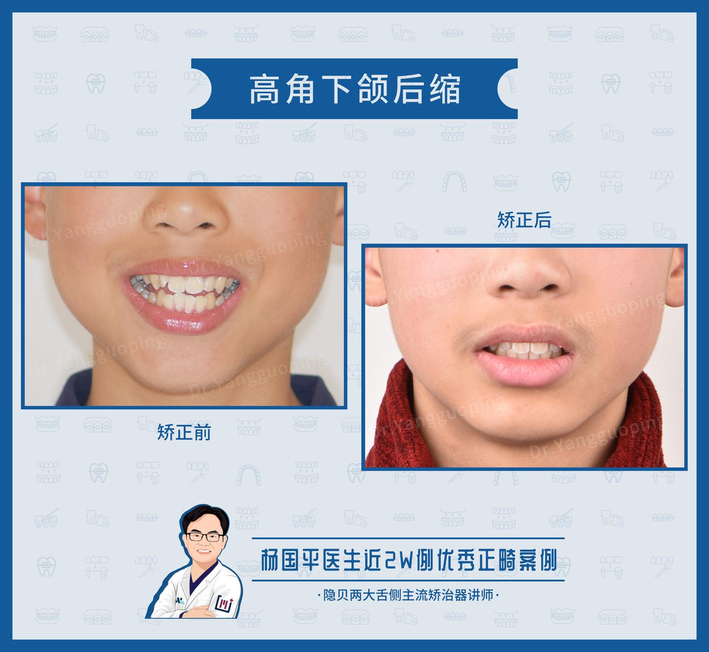 上海牙齿矫正:舌侧矫正案例no.633,上下牙列片切解决高角下颌后缩