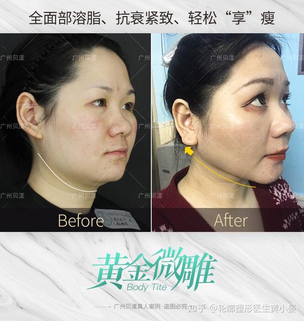 面部吸脂,光纤溶脂,黄金微雕和瘦脸针,这些瘦脸项目区别在哪?