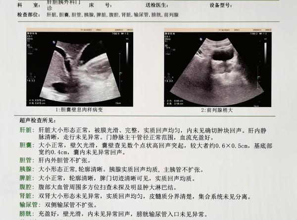 去年9月和今年5月两次彩超胆囊息肉位置不一样了,这次