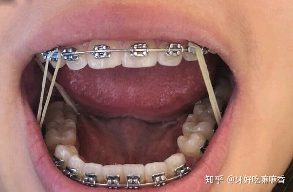 牙齿矫正中该如何收牙缝?