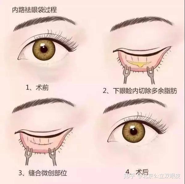 "外路祛眼袋"在下眼睑睫毛根部开口,将突出的眼眶脂肪取出,同时切除