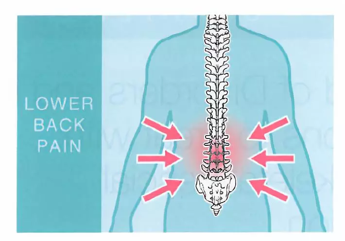 fm肌骨筋膜手法可处理的问题之下背痛篇