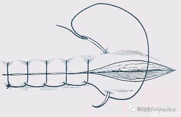 ③连续锁边缝合