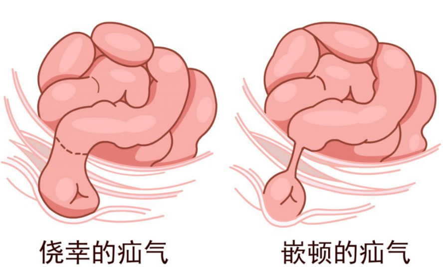 小儿疝气有什么病症