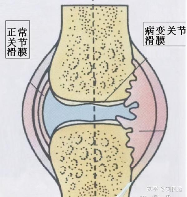 鹅足滑囊炎