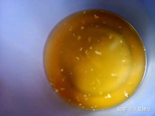 你们肾结石是怎么排出的看排石图