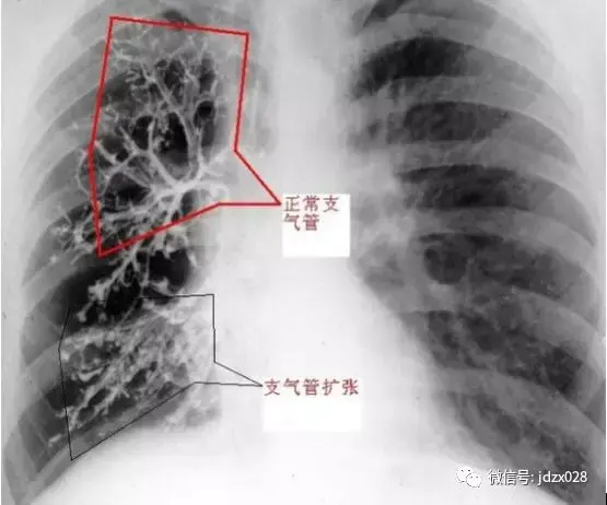 支气管扩张这样做,长期稳定不发作