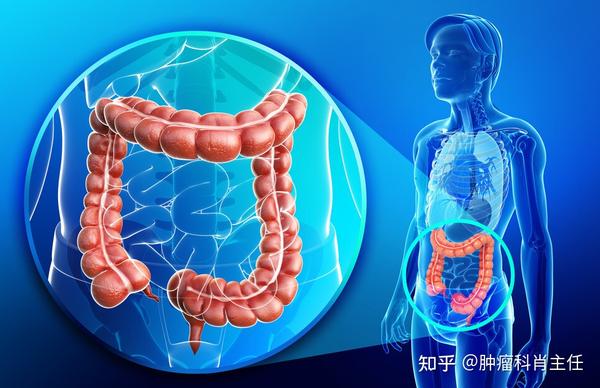 八成肠癌是由肠息肉癌变引起的关于肠息肉你了解多少