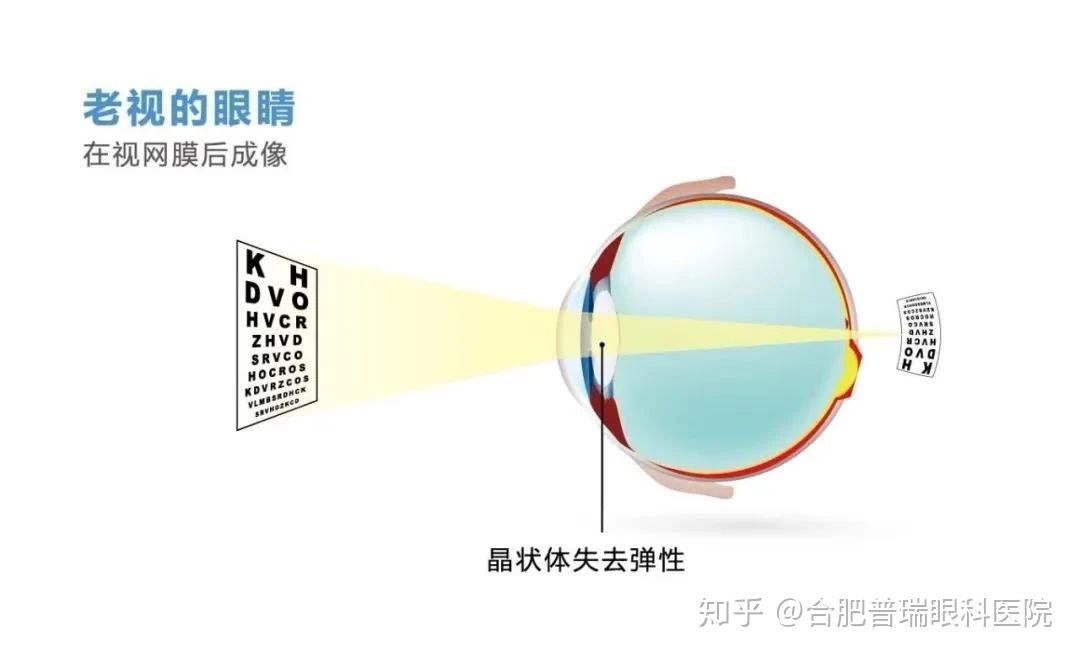远视是人眼看到的物体成像在视网膜的后方.