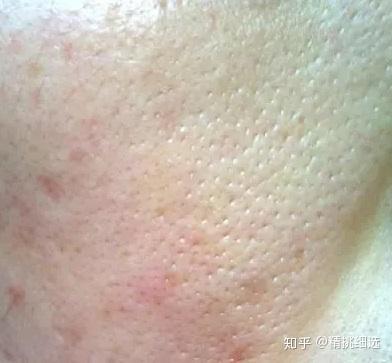 脸部皮肤毛孔粗大如何改善?