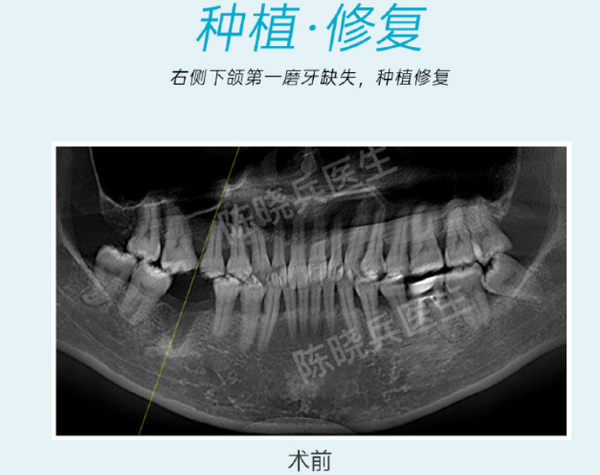 广州种植牙-陈晓兵-右侧下颌第一磨牙缺失6个月-种植案例