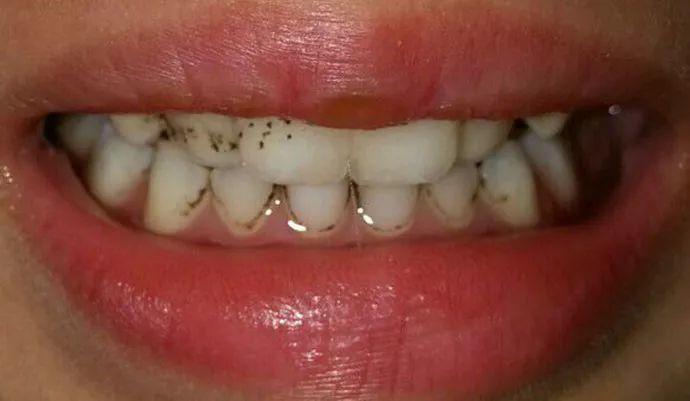 孩子牙齿上的小黑点究竟是什么? 松鼠牙医:好好刷牙就