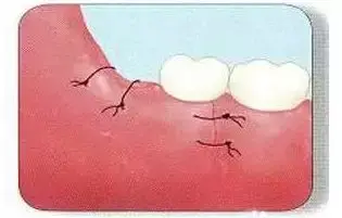 干槽症,牙医手里的生死符