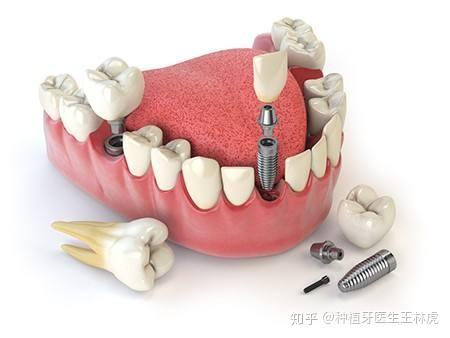 选择镶牙修复的缺牙患者也越来越多,而种植牙因其坚固耐用且舒适美观