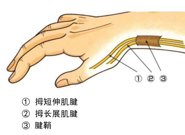 很大程度是拇短伸肌和拇长展肌腱鞘的 慢性炎症引起.