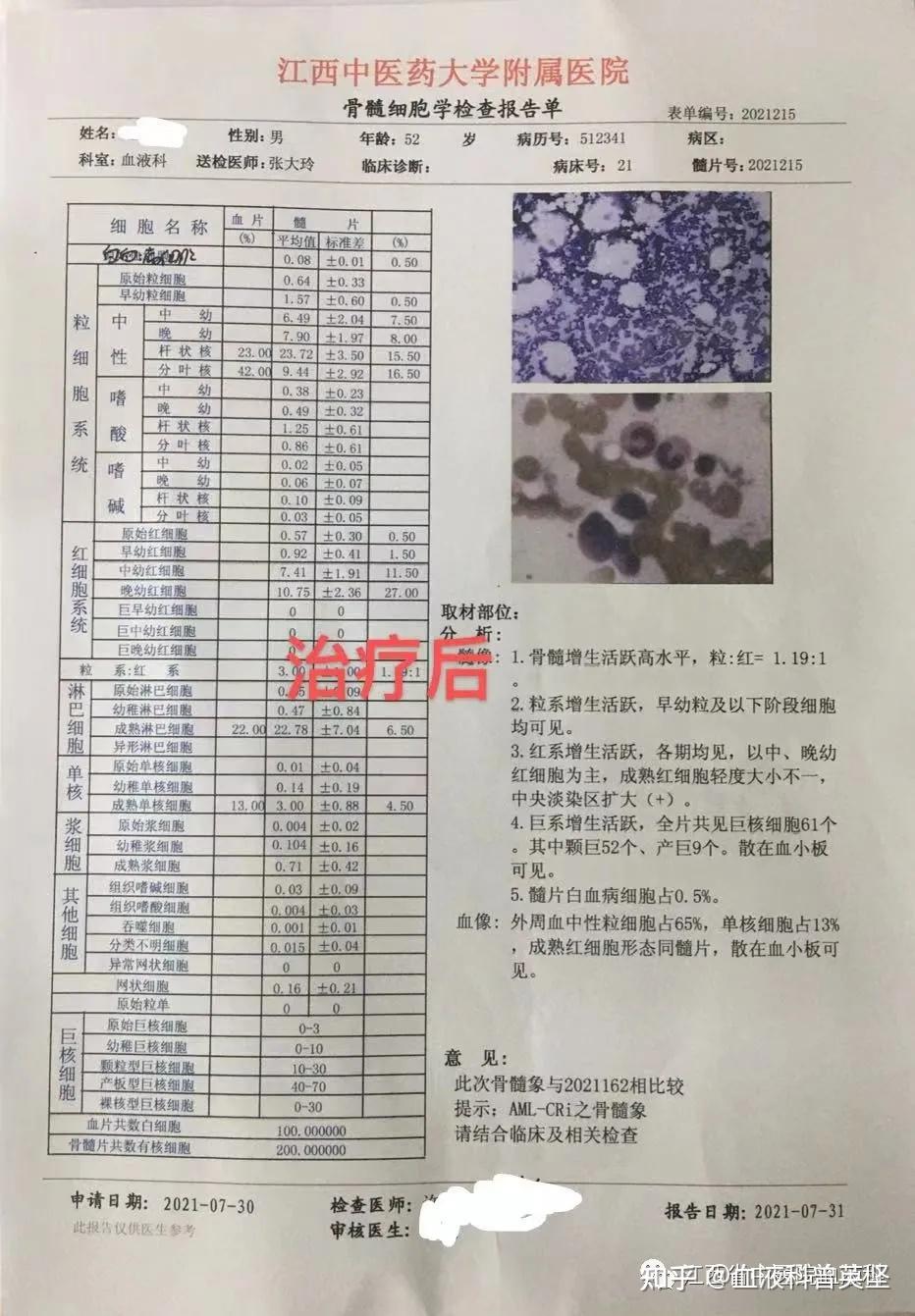 中西双剑合璧缓解急性髓系白血病