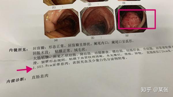 19岁女 记录第一次住院 肠镜 内镜下直肠息肉切除手术