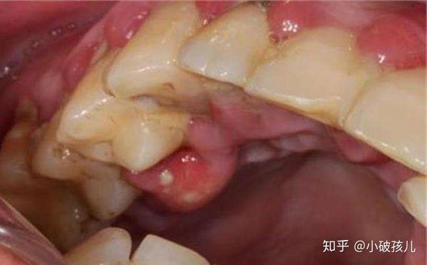 你试过牙龈长脓包吗?是怎么回事呢?