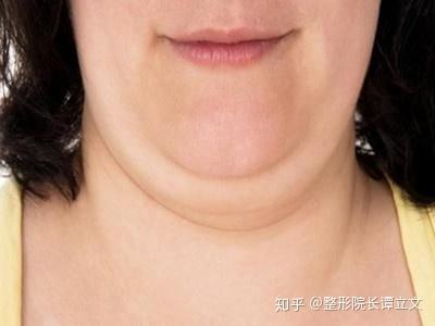 1双下巴明显